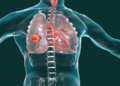 Diagnóstico temprano y avances reducen muerte cáncer pulmón