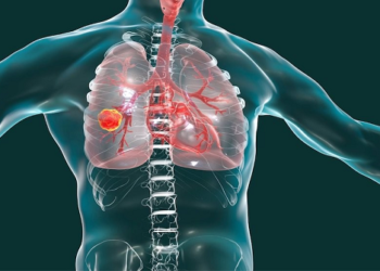 Diagnóstico temprano y avances reducen muerte cáncer pulmón