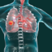 Diagnóstico temprano y avances reducen muerte cáncer pulmón