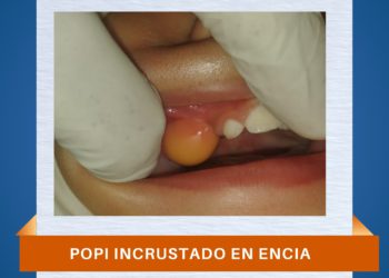IRMIE ADVIERTE SOBRE PELIGRO DE “POPIT’S” EN LOS NIÑOS