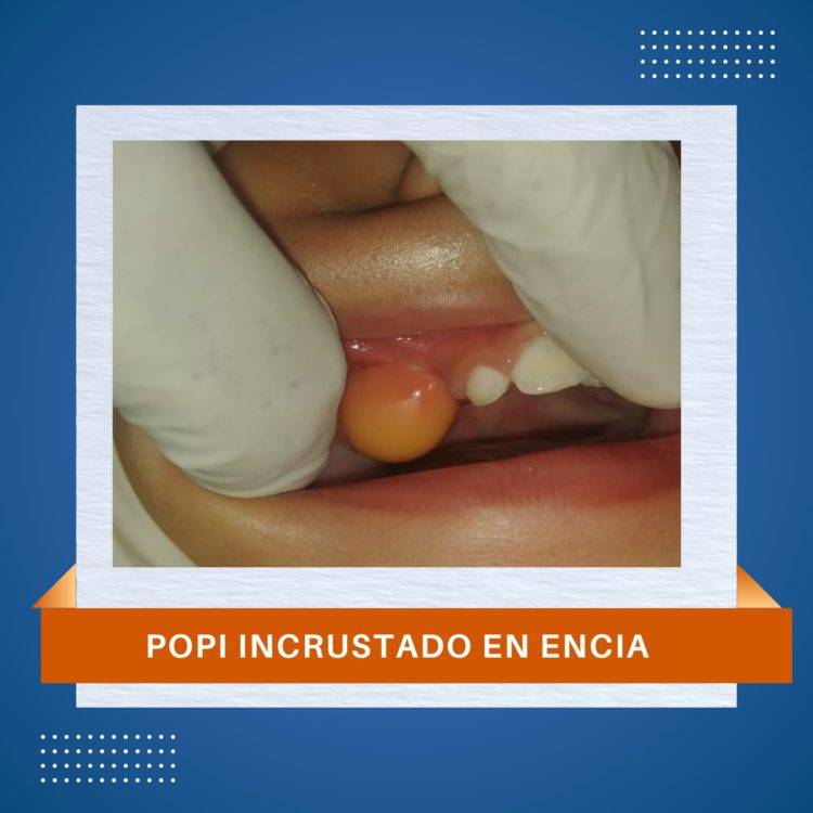 IRMIE ADVIERTE SOBRE PELIGRO DE “POPIT’S” EN LOS NIÑOS